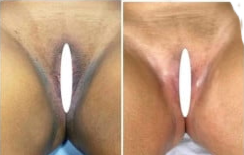 Virilhas Escura ou Pós Depilação