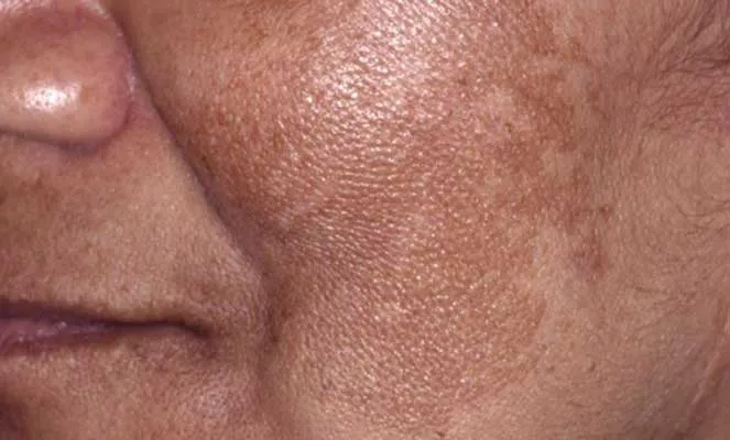 Melasma